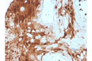 Formalin-fixed, paraffin-embedded human skin carcinoma stained with Calprotectin Mouse Monoclonal Antibody (S100A9/1075). (S100A9 antibody)