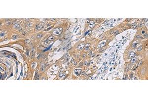 Immunohistochemistry of paraffin-embedded Human esophagus cancer tissue using PA2G4 Polyclonal Antibody at dilution of 1:60(x200) (PA2G4 antibody)