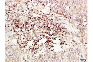 Formalin-fixed and paraffin embedded human lung carcinoma labeled with Anti-CD184/CXCR4 Polyclonal Antibody (ABIN730888), Unconjugated at 1:200, followed by conjugation to the secondary antibody and DAB staining
