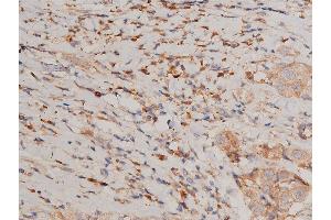 ABIN6267231 at 1/200 staining human breast cancer tissue sections by IHC-P. (IKK alpha antibody  (pSer176, pSer177))