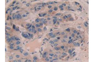 IHC-P analysis of Human Breast Cancer Tissue, with DAB staining. (Contactin 4 antibody  (AA 731-980))