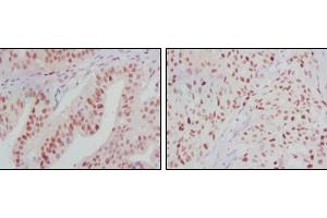 Immunohistochemical analysis of paraffin-embedded human ovarian cancer (left) and breast cancer (right) tissues using ATP2C1 mouse mAb with DAB staining.