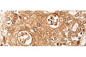 Immunohistochemistry of paraffin-embedded Human prost ate cancer tissue using ZPR1 Polyclonal Antibody at dilution of 1:40(x200)