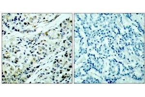 Immunohistochemical analysis of paraffin-embedded human breast carcinoma tissue, using HDAC5 (phospho-Ser498) antibody (E011193). (HDAC5 antibody  (pSer498))