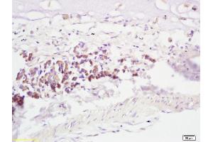 Formalin-fixed and paraffin embedded human lung carcinoma labeled with Anti-RNF43 Polyclonal Antibody, Unconjugated (ABIN721600) at 1:200, followed by conjugation to the secondary antibody and DAB staining