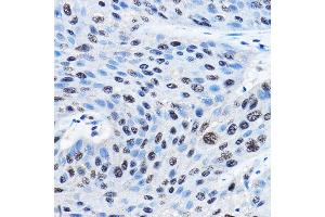 Immunohistochemistry of paraffin-embedded human esophageal cancer using NUDT21 Rabbit pAb (ABIN1681134, ABIN3018973, ABIN3018974 and ABIN6220652) at dilution of 1:100 (40x lens). (NUDT21 antibody  (AA 1-227))