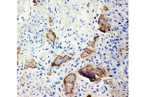 Anti-Bone Sialoprotein antibody, (ABIN3044423), IHC(P)IHC(P): Human Osteosarcoma Tissue