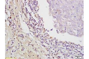 Formalin-fixed and paraffin embedded human breast carcinoma labeled with Rabbit Anti EMR1 Polyclonal Antibody, Unconjugated (ABIN1387314) at 1:200 followed by conjugation to the secondary antibody and DAB staining