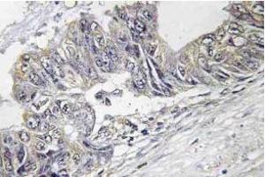 Immunohistochemistry (IHC) analyzes of p-JNK1/2/3 antibody in paraffin-embedded human colon carcinoma tissue. (JNK antibody  (pThr183))
