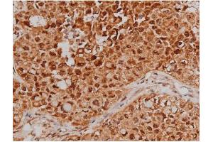 ABIN6267363 at 1/200 staining Human lung cancer tissue sections by IHC-P. (MAPT antibody  (pSer262))