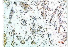 Immunohistochemical analysis of paraffin-embedded human-stomach-cancer, antibody was diluted at 1:200 (FCGR1A antibody  (AA 230-280))