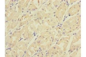 Immunohistochemistry of paraffin-embedded human gastric cancer using ABIN7147210 at dilution of 1:100 (CDC42EP2 antibody  (AA 9-210))