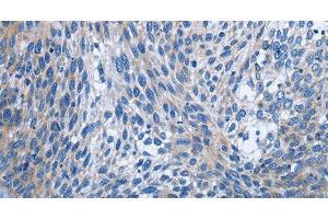 Immunohistochemistry of paraffin-embedded Human cervical cancer using IL2RB Polyclonal Antibody at dilution of 1:30 (IL2 Receptor beta antibody)