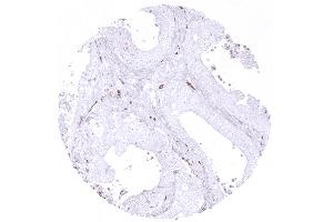 Adenocarcinoma of the colon with low content of CD163 positive macrophages (CD163 antibody  (AA 43-196))