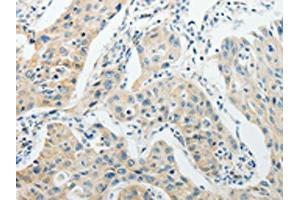 The image on the left is immunohistochemistry of paraffin-embedded Human lung cancer tissue using ABIN7189714(AGBL1 Antibody) at dilution 1/15, on the right is treated with synthetic peptide. (AGBL1 antibody)