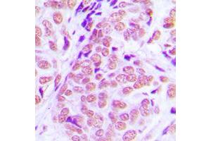 Immunohistochemical analysis of NFIA staining in human breast cancer formalin fixed paraffin embedded tissue section.