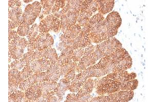 Formalin-fixed, paraffin-embedded human Basal Cell Carcinoma stained with EpCAM Rabbit Recombinant Monoclonal Antibody (EGP40/2041R).
