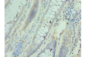Immunohistochemistry of paraffin-embedded human colon cancer using ABIN7171427 at dilution of 1:100 (CCT3 antibody  (AA 1-300))