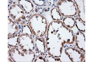 Immunohistochemical staining of paraffin-embedded Adenocarcinoma of ovary tissue using anti-ANXA1 mouse monoclonal antibody.