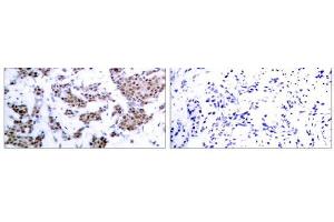 Immunohistochemical analysis of paraffin-embedded human breast carcinoma tissue, using MEF2A (phospho-Thr312) antibody (E011039). (MEF2A antibody  (pThr312))