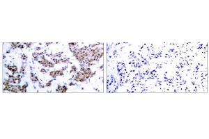 Immunohistochemical analysis of paraffin-embedded human breast carcinoma tissue, using MEF2A (phospho-Thr312) antibody (E011039). (MEF2A antibody  (pThr312))