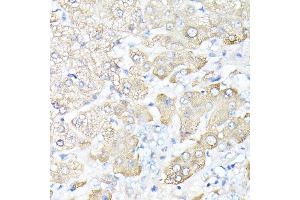 Immunohistochemistry of paraffin-embedded human liver cancer using Haptoglobin (Haptoglobin (HP)) antibody (ABIN3022157, ABIN3022158, ABIN1513029, ABIN1514188 and ABIN6218636) at dilution of 1:100 (40x lens). (Haptoglobin antibody)