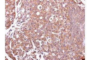 IHC-P Image Mucin 4 antibody detects Mucin 4 protein at cytosol on human breast carcinoma by immunohistochemical analysis. (MUC4 antibody)