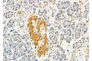 ABIN6260353 and ABIN6277507 at 1/100 staining Human pancreatic cancer and adjacent nomal tissues by IHC-P.