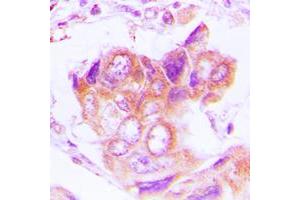 Immunohistochemical analysis of PSMD2 staining in human lung cancer formalin fixed paraffin embedded tissue section. (PSMD2 antibody  (N-Term))