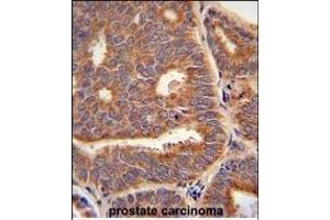 PTPLB Antibody (C-term) (ABIN651166 and ABIN2840107) immunohistochemistry analysis in formalin fixed and paraffin embedded human prostate carcinoma followed by peroxidase conjugation of the secondary antibody and DAB staining. (PTPLB antibody  (C-Term))