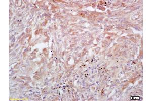 Formalin-fixed and paraffin embedded human lung carcinoma labeled with Rabbit Anti Trk A/B/C Polyclonal Antibody, Unconjugated (ABIN726095) at 1:200 followed by conjugation to the secondary antibody and DAB staining (TrkA, B, C (AA 668-750) antibody)