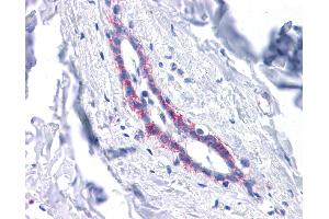 Immunohistochemistry (IHC) image for anti-Cadherin 1, Type 1, E-Cadherin (Epithelial) (CDH1) (Middle Region) antibody (ABIN2784498) (E-cadherin antibody  (Middle Region))