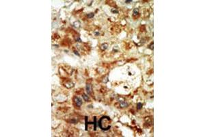 Formalin-fixed and paraffin-embedded human hepatocellular carcinoma tissue reacted with MAPK12 polyclonal antibody  , which was peroxidase-conjugated to the secondary antibody, followed by AEC staining. (MAPK12 antibody  (Internal Region))