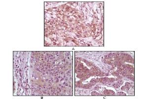 Immunohistochemical analysis of paraffin-embedded human pancreas carcinoma (A), esophagus carcinoma tissue (B) and ovary tumor tissue (C), showing cytoplasmic and membrane localization using 4E-BP1 antibody with DAB staining. (eIF4EBP1 antibody)
