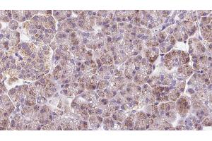 ABIN6273233 at 1/100 staining Human pancreas cancer tissue by IHC-P. (DYNC2LI1 antibody  (Internal Region))