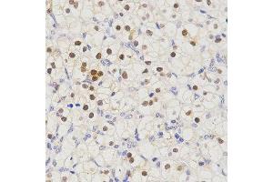 Immunohistochemistry of paraffin-embedded human kidney cancer tissue using SCTR antibody at dilution of 1:200 (x400 lens)