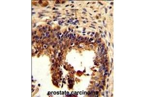 Formalin-fixed and paraffin-embedded human prostate carcinoma reacted with KRT4 Antibody (C-term), which was peroxidase-conjugated to the secondary antibody, followed by DAB staining. (KRT4 antibody  (C-Term))