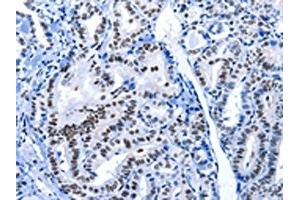The image on the left is immunohistochemistry of paraffin-embedded Human thyroid cancer tissue using ABIN7191961(POU2AF1 Antibody) at dilution 1/15, on the right is treated with synthetic peptide. (POU2AF1 antibody)