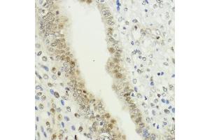 Immunohistochemistry of paraffin-embedded human uterine cancer using LDB1 antibody (ABIN7268255) at dilution of 1:200 (40x lens).