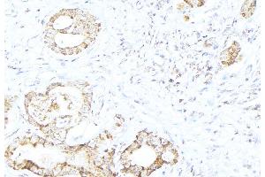 ABIN6268921 at 1/100 staining Human lung cancer tissue by IHC-P. (HSPD1 antibody)