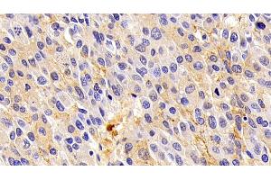 Detection of ORM2 in Human Liver cancer Tissue using Polyclonal Antibody to Orosomucoid 2 (ORM2) (Orosomucoid 2 antibody)