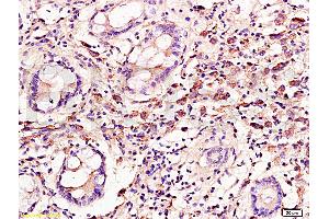 Formalin-fixed and paraffin embedded: human colon carcinoma labeled with Anti-Cyclin C Polyclonal Antibody, Unconjugated (ABIN727250) at 1:300, followed by conjugation to the secondary antibody and DAB staining (Cyclin C antibody  (AA 23-100))