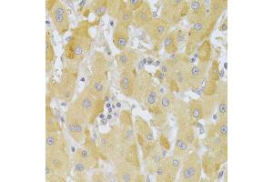 Immunohistochemistry of paraffin-embedded human liver cancer using SNAI2 Antibody (ABIN5970416) at dilution of 1/100 (40x lens). (SLUG antibody)