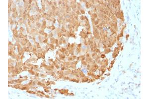 Formalin-fixed, paraffin-embedded human Melanoma stained with S100A1 Mouse Monoclonal Antibody (S100A1/1942). (S100A1 antibody)