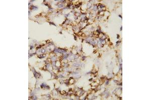 Anti-N Cadherin antibody, IHC(P) IHC(P): Human Ovary Cancer Tissue (N-Cadherin antibody  (Middle Region))