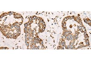Immunohistochemistry of paraffin-embedded Human esophagus cancer tissue using CAPN9 Polyclonal Antibody at dilution of 1:45(x200)