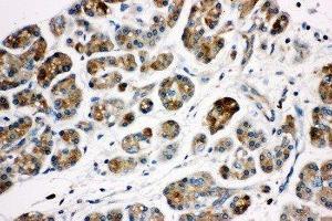 Anti-Kallikrein 1 antibody, IHC(P) IHC(P): Human Pancreatic Cancer Tissue (Kallikrein 1 antibody  (Middle Region))