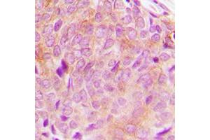 Immunohistochemical analysis of PLC gamma 2 staining in human breast cancer formalin fixed paraffin embedded tissue section. (Phospholipase C gamma 2 antibody  (C-Term))
