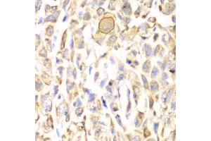 Immunohistochemistry of paraffin-embedded human lung cancer using CD151 antibody at dilution of 1:200 (400x lens). (CD151 antibody)