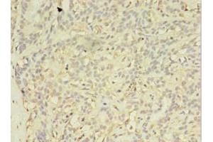 Immunohistochemistry of paraffin-embedded human breast cancer using ABIN7152293 at dilution of 1:100